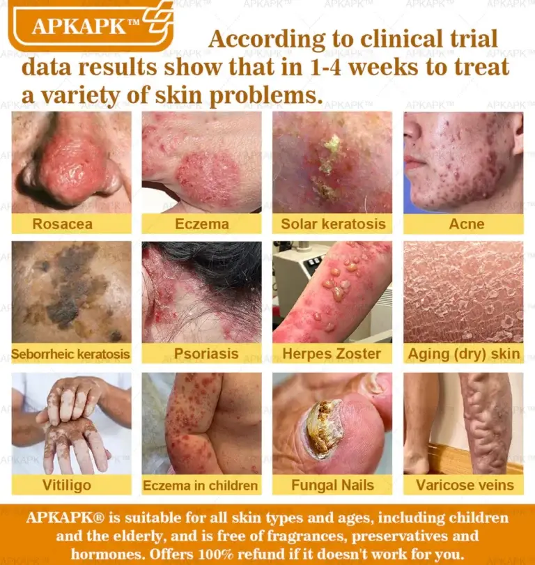 APKAPK™ Bee Venom Skin Treatment Cream 18 APKAPK™ Bee Venom Skin Treatment Cream