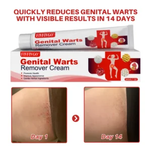 Fivfivgo® FloraGuard HPV Genital Warts Remover 11 Fivfivgo® FloraGuard HPV Genital Warts Remover