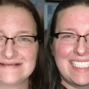 HZA™ Custom-Fit Functional Dentures