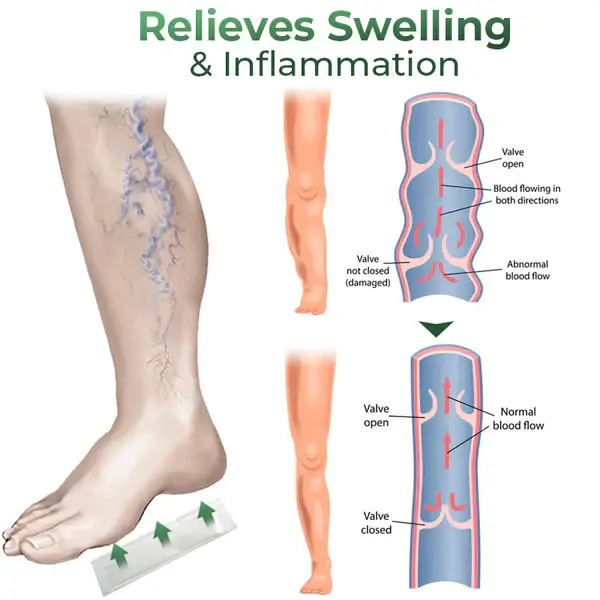 Cvreoz® Varicose Vein Relief Herbal Foot Patch 6 Cvreoz® Varicose Vein Relief Herbal Foot Patch