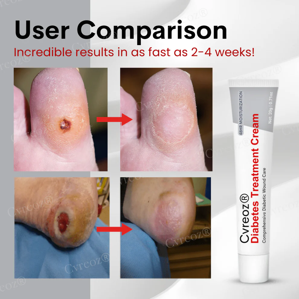 Cvreoz® Diabetes Treatment Cream 8 Cvreoz® Diabetes Treatment Cream