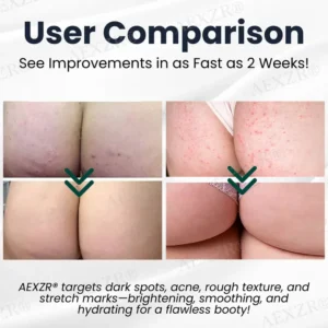 AEXZR® Butt Skin Treatment Cream