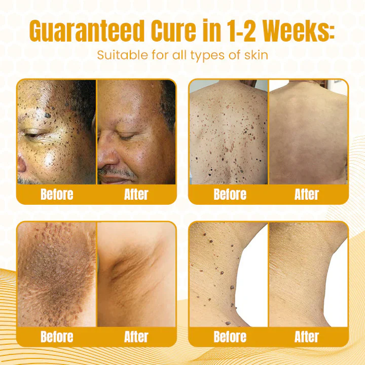 Fivfivgo™ Bee Venom Multi-Skin Treatment Spray 4 Fivfivgo™ Bee Venom Multi-Skin Treatment Spray