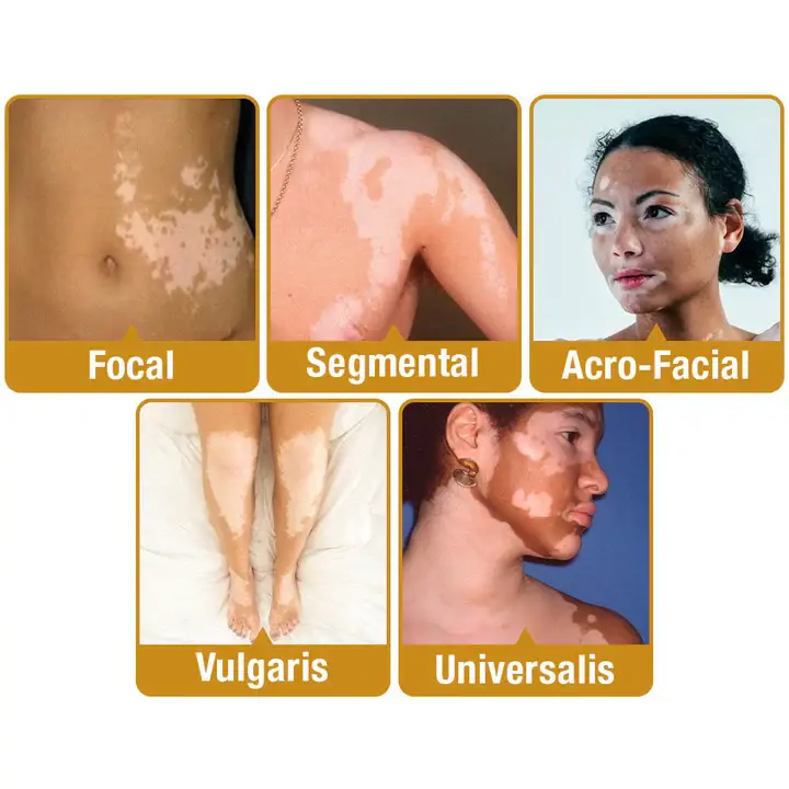 Dobshow™ BeeVenom Vitiligo Treatment Cream 9 Dobshow™ BeeVenom Vitiligo Treatment Cream