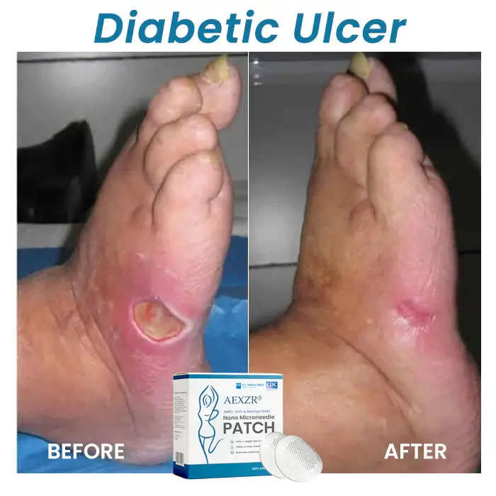 AEXZR® SMGT-GLP1 & Matrixyl 3000 Nano Microneedle Patch 8 AEXZR® SMGT-GLP1 & Matrixyl 3000 Nano Microneedle Patch