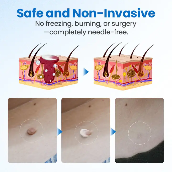 Timilk® TagGone Wart Removal Cream 5 Timilk® TagGone Wart Removal Cream