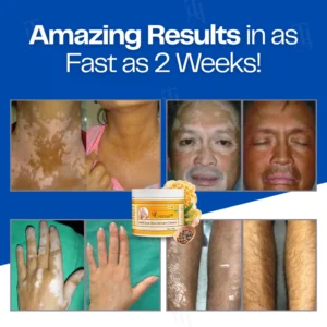 Cvreoz® VitiClear Bee Venom Cream 9 Cvreoz® VitiClear Bee Venom Cream