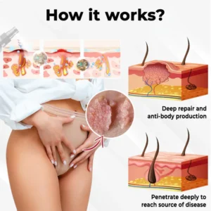 Fivfivgo® Female HPV Genital Wart Caring Spray 13 Fivfivgo® Female HPV Genital Wart Caring Spray