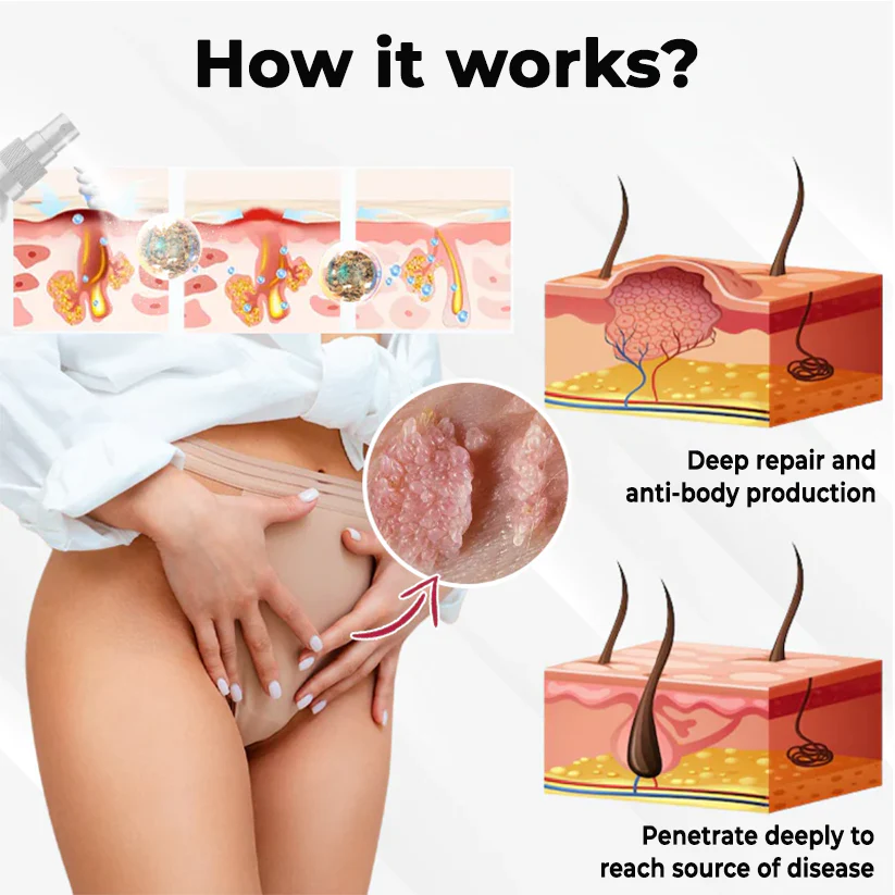 Fivfivgo® Female HPV Genital Wart Caring Spray 5 Fivfivgo® Female HPV Genital Wart Caring Spray