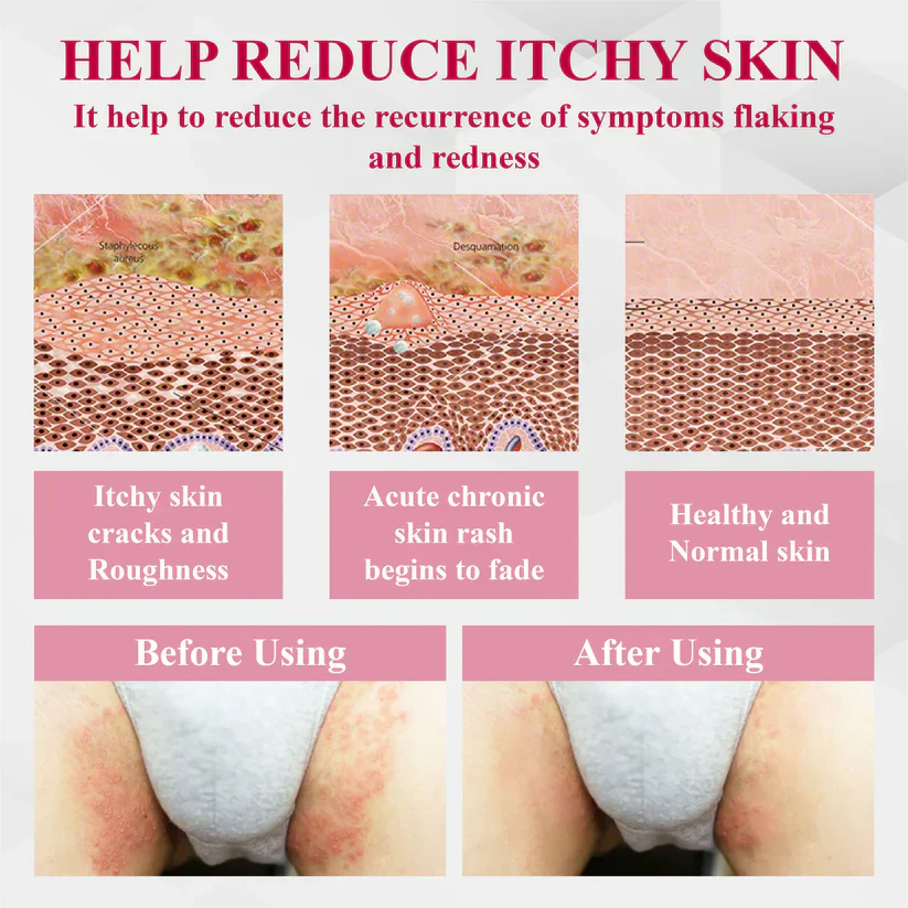 Fivfivgo® Woman's Genital HPV Healing Cream 7 Fivfivgo® Woman's Genital HPV Healing Cream