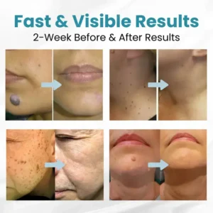 LAOZIK® Non-Invasive Mole and Wart Removal Laser Pen 11 LAOZIK® Non-Invasive Mole and Wart Removal Laser Pen