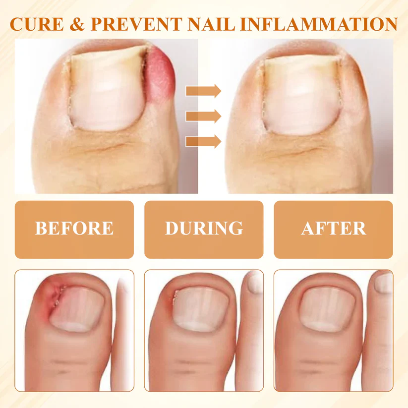 Fivfivgo® Fungiclear Bee Therapy Nail Spray 6 Fivfivgo® Fungiclear Bee Therapy Nail Spray