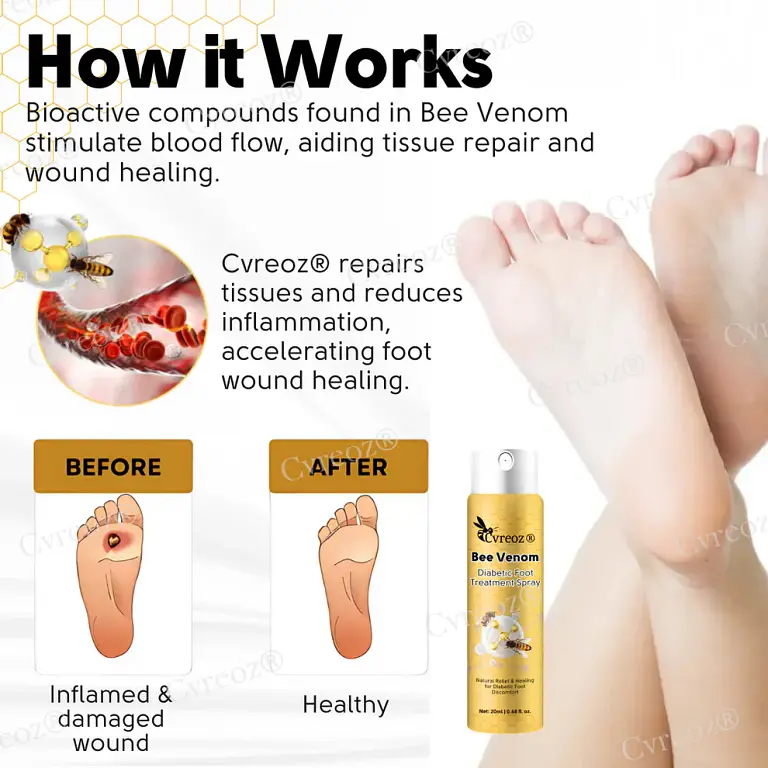 Cvreoz® Bee Venom Diabetic Foot Treatment Spray 3 Cvreoz® Bee Venom Diabetic Foot Treatment Spray