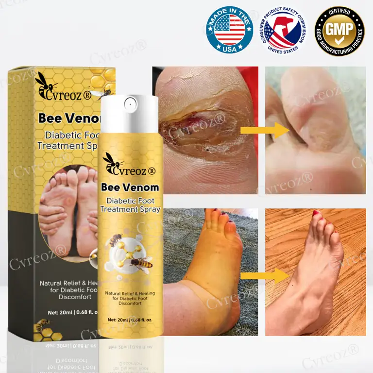 Cvreoz® Bee Venom Diabetic Foot Treatment Spray 2 Cvreoz® Bee Venom Diabetic Foot Treatment Spray