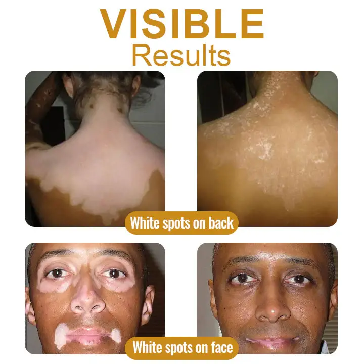 Dobshow™ BeeVenom Vitiligo Treatment Cream 5 Dobshow™ BeeVenom Vitiligo Treatment Cream