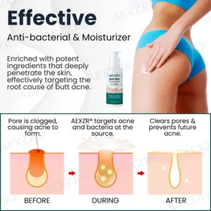 AEXZR® Butt Skin Treatment Cream