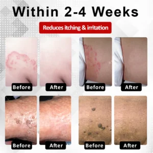 Fivfivgo® Men's HPV Warts Care Spray 16 Fivfivgo® Men's HPV Warts Care Spray