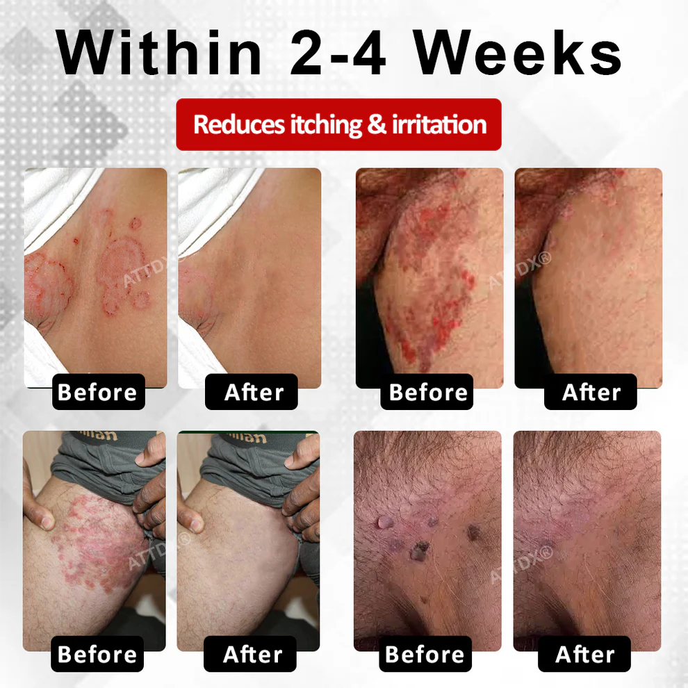 Fivfivgo® Men's HPV Warts Care Spray 4 Fivfivgo® Men's HPV Warts Fivfivgo® Men's HPV Warts Care SprayCare Spray