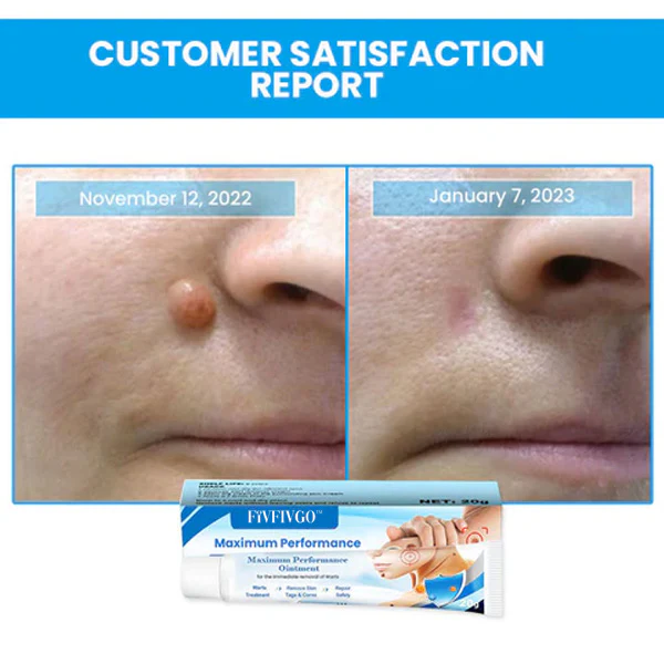 Fivfivgo™ Maximum Performance Ointment for the Immediate removal of Warts 5 Fivfivgo™ Maximum Performance Ointment for the Immediate removal of Warts