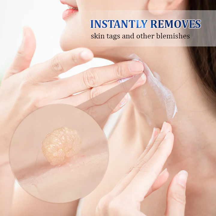 Fivfivgo™ WartsOff Instant Blemish Removal Cream – PREMIUM 8 Fivfivgo™ WartsOff Instant Blemish Removal Cream – PREMIUM