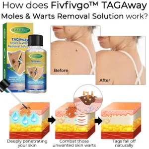 Fivfivgo™ TAGAway Moles & Warts Removal Solution 7 Fivfivgo™ TAGAway Moles & Warts Removal Solution