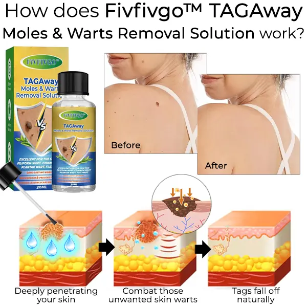 Fivfivgo™ TAGAway Moles & Warts Removal Solution 4 Fivfivgo™ TAGAway Moles & Warts Removal Solution