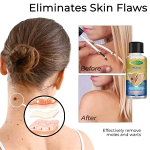 Fivfivgo™ TAGAway Moles & Warts Removal Solution 6 Fivfivgo™ TAGAway Moles & Warts Removal Solution
