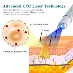 Bikenda® LumeSkin Mole and Wart Removal Laser Pen 14 Bikenda® LumeSkin Mole and Wart Removal Laser Pen