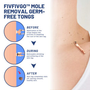 Fivfivgo™ Mole Removal Germ-Free Tongs 13 Fivfivgo™ Mole Removal Germ-Free Tongs