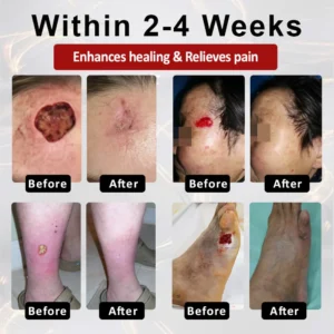 CVREOZ® DiaCure Bee Venom & Centella Diabetic Foot Ulcer Spray 15 CVREOZ® DiaCure Bee Venom & Centella Diabetic Foot Ulcer Spray