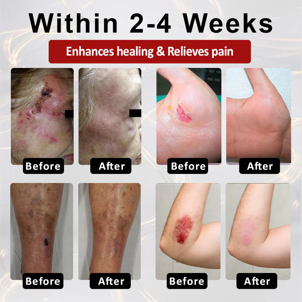 CVREOZ® DiaCure Bee Venom & Centella Diabetic Foot Ulcer Spray 5 CVREOZ® DiaCure Bee Venom & Centella Diabetic Foot Ulcer Spray