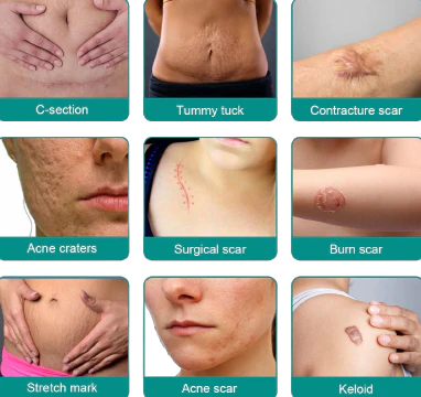 Fivfivgo™ Advanced Scar Removal Spray 3 Fivfivgo™ Advanced Scar Removal Spray