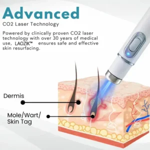LAOZIK® Non-Invasive Mole and Wart Removal Laser Pen 9 LAOZIK® Non-Invasive Mole and Wart Removal Laser Pen