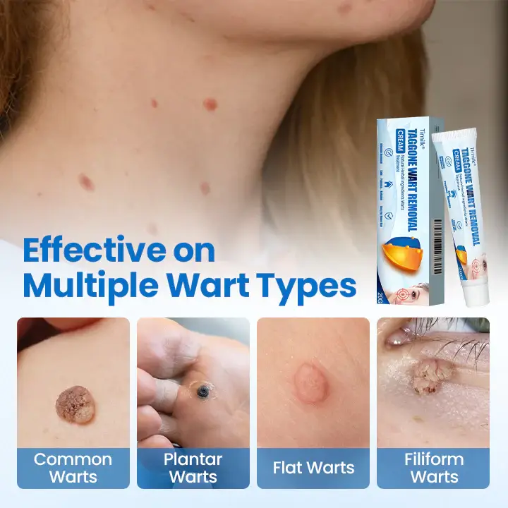 Timilk® TagGone Wart Removal Cream 2 Timilk® TagGone Wart Removal Cream