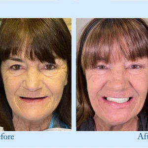 Smileasego™ - Premium Denture