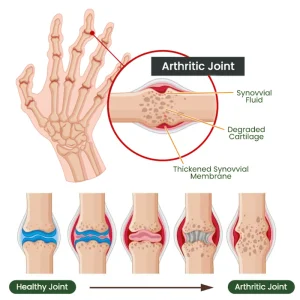 Adfire® Bee Venom Bone & Joint Revive Spray 15 Adfire® Bee Venom Bone & Joint Revive Spray