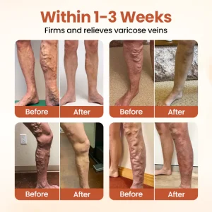 Timilk® VeinTarget Microneedle Patch 15 Timilk® VeinTarget Microneedle Patch