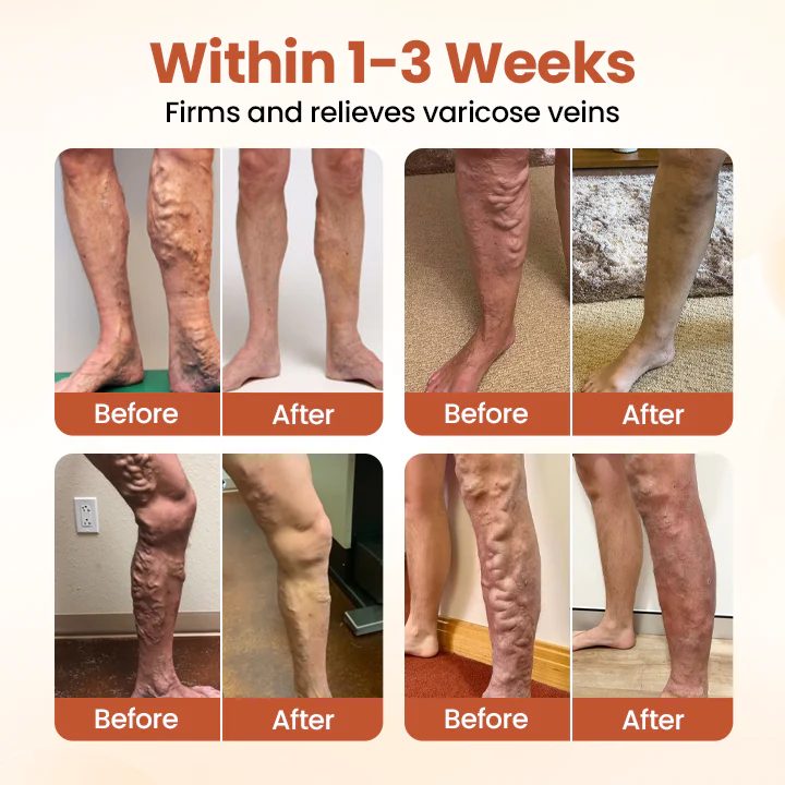 Timilk® VeinTarget Microneedle Patch 5 Timilk® VeinTarget Microneedle Patch