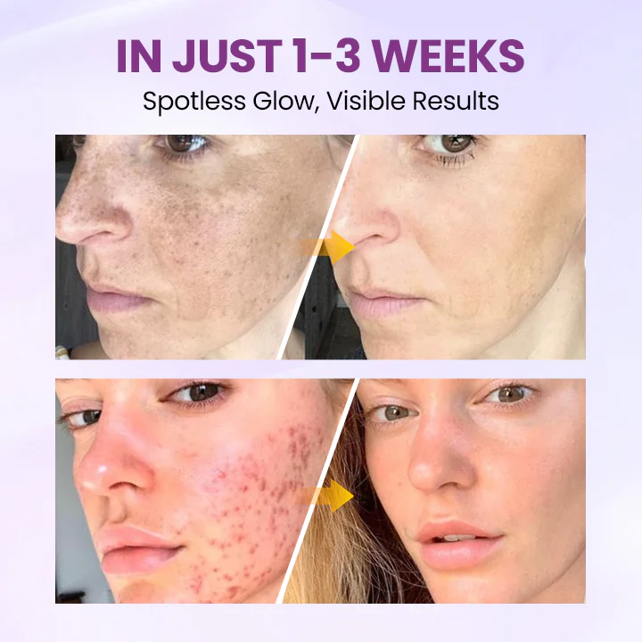 Biancat® RadiantClear Blemish & Brightening Serum 4 Biancat® RadiantClear Blemish & Brightening Serum