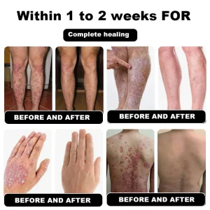 NESLEMY™ Psoriasis Cure Cream 18 NESLEMY™ Psoriasis Cure Cream