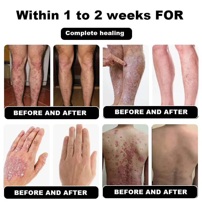 NESLEMY™ Psoriasis Cure Cream 8 NESLEMY™ Psoriasis Cure Cream