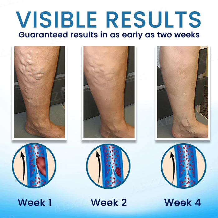 Cvreoz® Herbal Varicose Veins Treatment Spray 3 Cvreoz® Herbal Varicose Veins Treatment Spray