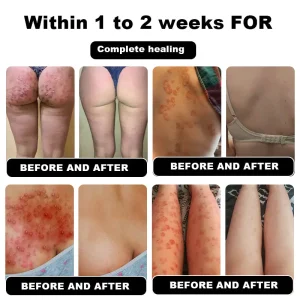 NESLEMY™ Psoriasis Cure Cream 17 NESLEMY™ Psoriasis Cure Cream