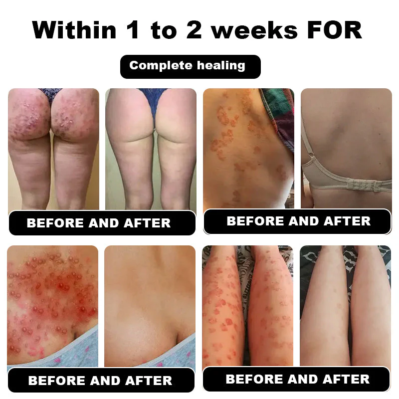 NESLEMY™ Psoriasis Cure Cream 7 NESLEMY™ Psoriasis Cure Cream