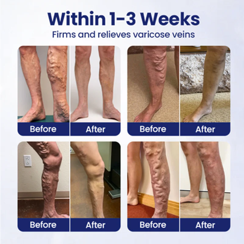 Furzero® VeinFreedom Herbal Spray 6 Furzero® VeinFreedom Herbal Spray