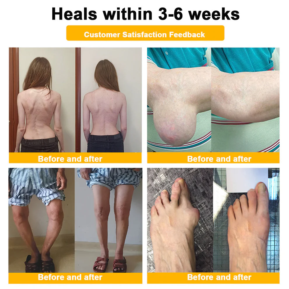 Raindew® Botulinum Toxin & Bee Venom Pain-Relief Bone Healing Cream 5 Raindew® Botulinum Toxin & Bee Venom Pain-Relief Bone Healing Cream