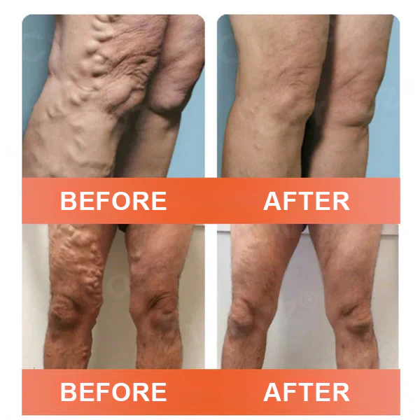 Seurico™ VeinEase Mikronadel-Therapie- Aufnaher 2 Seurico™ VeinEase Mikronadel-Therapie- Aufnaher