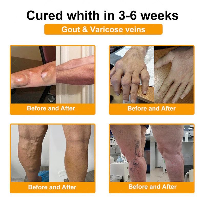 Jorondy® Bee Venom Pain-Relief Bone Healing Spray 8 Jorondy® Bee Venom Pain-Relief Bone Healing Spray