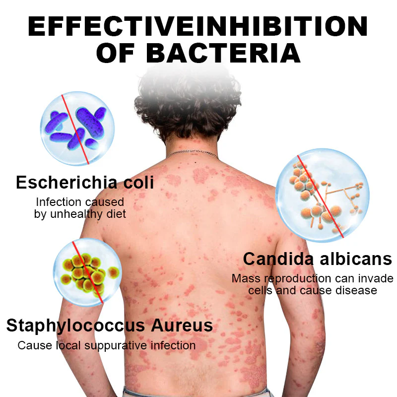 NESLEMY™ Psoriasis Cure Cream 4 NESLEMY™ Psoriasis Cure Cream