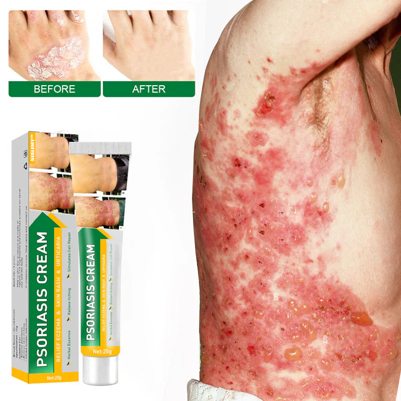 NESLEMY™ Psoriasis Cure Cream 3 NESLEMY™ Psoriasis Cure Cream